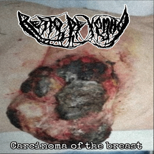 Resto De Vomito : Carcinoma of the Breast